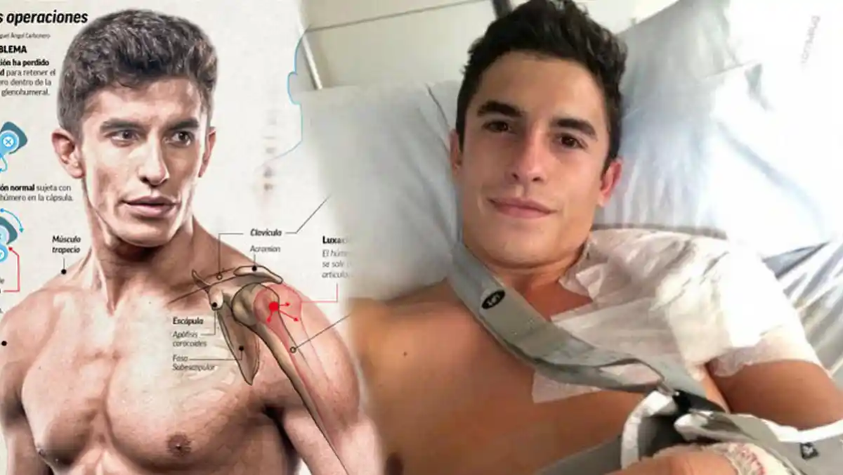 Lengan Marc Marquez